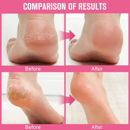 Crema Hidratante Antiagrietamiento Con Urea Para Manos Y Pie