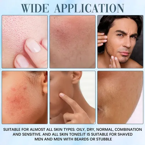 Norse Organics Acne Killer, Kit For El Cuidado De La Piel