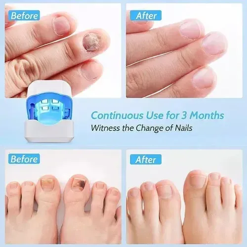 Manicura Lámpara Electrónica De Fototerapia Lámpara &av &ru