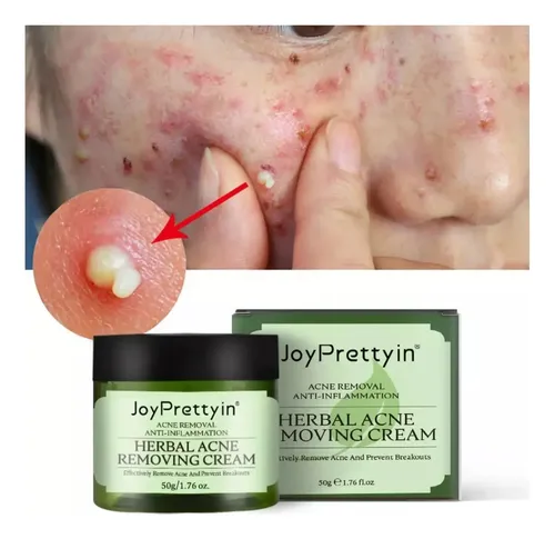 Ai Crema Facial Antiacné, Elimina Profesionalmente Las