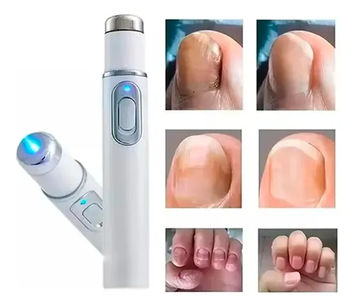 Tratamiento Láser Uñas Hongos Onicomicosis Manos Pies Eficaz