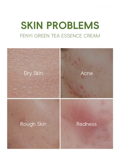 Fenyi Green Tea Essence Cream – Reparación De Acné 40g