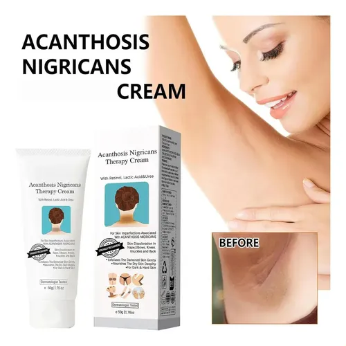Crema 2026 Antiacantosis | Aclara + Suaviza Piel Oscura