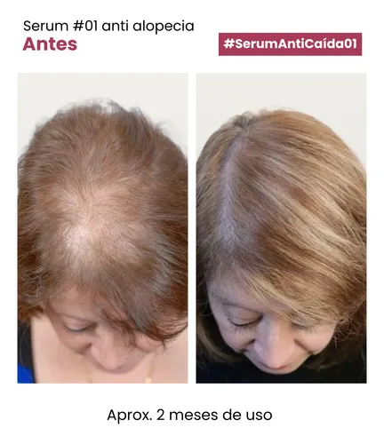 Serum Anti Caída #01 Acelera El Crecimiento Y Evita La Caída