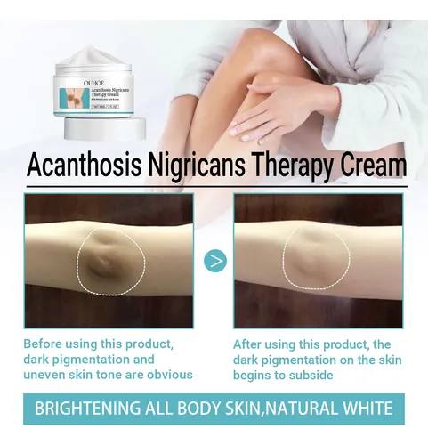 La Crema Reutilizable Para Dermatomas Con Puntos Negros Ouho