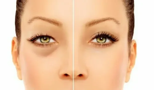 Serum Lipo Lifting De Ojos Carthage Para Bolsas Y Ojeras Dra