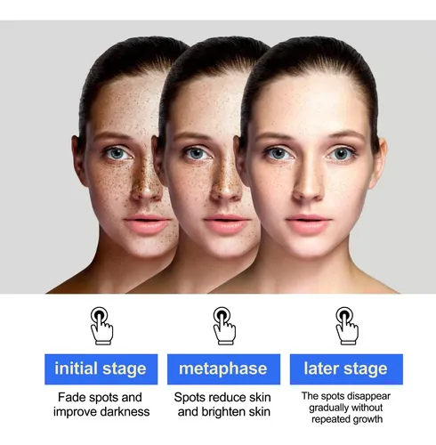 Crema Iluminadora Única Para Manchas Faciales, 50 G, Melasma