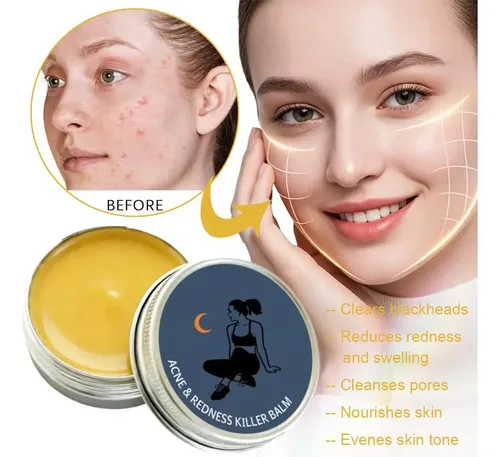 Bálsamo Para El Cuidado De La Piel Facial, Acné Y Enrojecimi