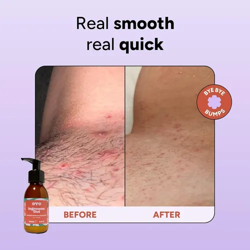 Oyo Exfoliante Para Vello Encarnado 100 Ml