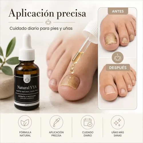 Aceite para hongos de Uñas de los Pies y Manos 30ml. Natural Vya Antimicotico Accion Terapeutica Rapida Accion Aceite de Ricino Arbol de Té
