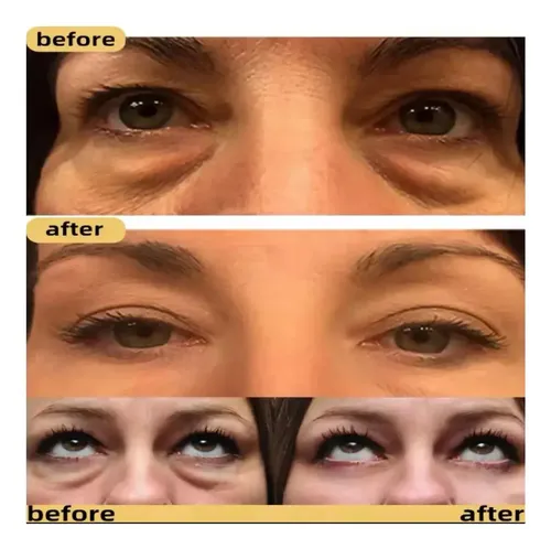 Serum Roll On Contorno De Ojos Retinol Bolsas 15ml Sadoer Todo Tipo De Piel Noche