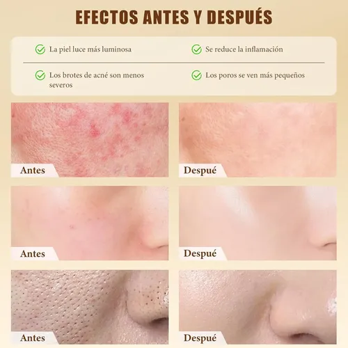 240 Ml De Ácido Glicólico Al 7% Tonifica, Exfolia Y J