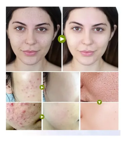 Crema Facial Antiacné Y Control De Aceite De Té Verde, 40 G