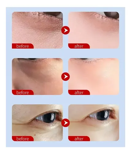 Set 2 Par Parche Colageno Remueve Bolsas De Los Ojos Ojeras Tipo De Piel Mixta