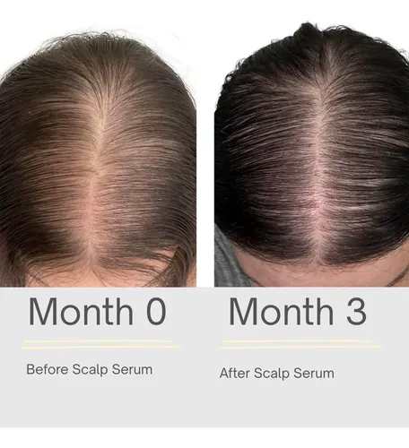 El Sérum Para El Crecimiento Del Cabello Limpia Suavemente E