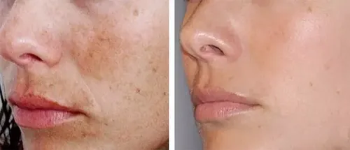 Crema Clarificante Con Liposomas Aclarantes Exel 30 Ml Momento De Aplicación Día Noche Tipo De Piel Todo Tipo De Piel