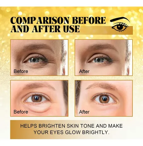 Tratamiento De Ojeras V-eye Para Eliminar Las Ojeras Com.p