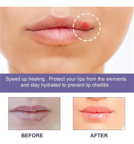 Tn 3 Parches Útiles For Aliviar El Herpes Labial Y Curar