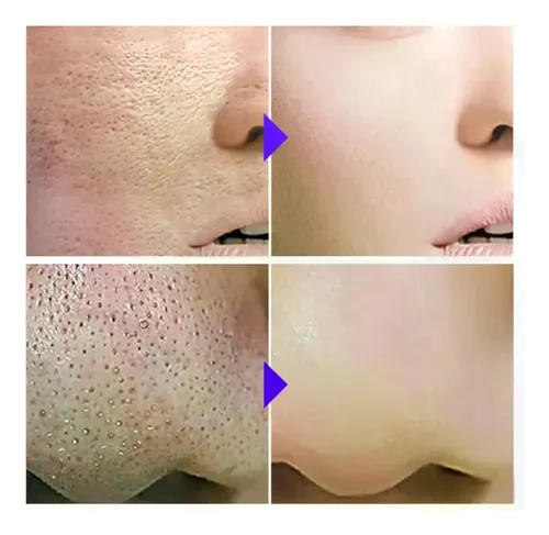 Sérum Facial Con Ácido Salicílico, Reduce Los Poros Y Contro