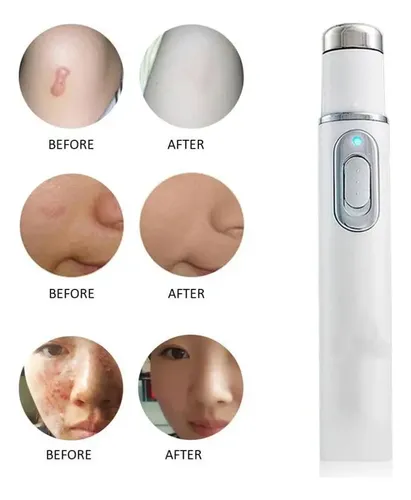 Tratamiento Laser Aclara Blanqueador Mancha Piel Zona Intima