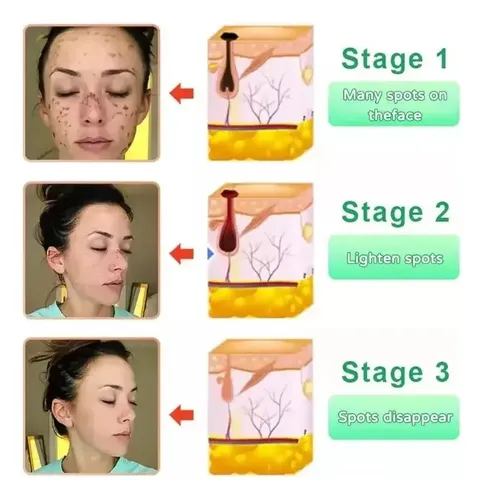 Quarxeri Purificante Exfoliante, Gel Exfoliante Avanzado Vs