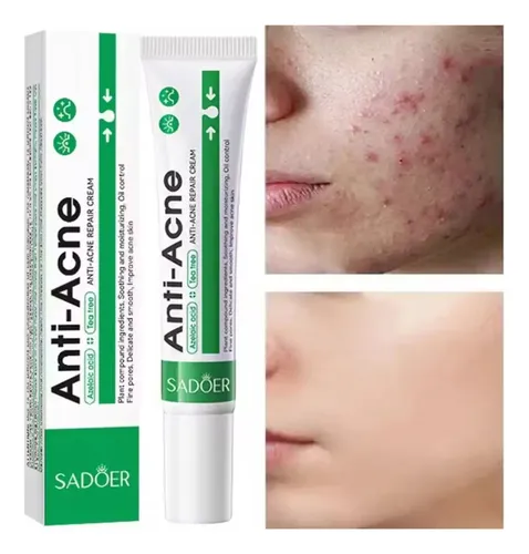 Crema Tratamiento Acne Granitos 100% Efectividad Todo Tipo De Piel Día/noche