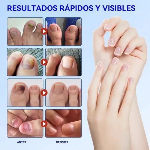 \\ Fc Parches Para Uñas Fúngicos 63pcs/caja De Parches Para