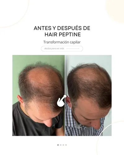 Peptine Hair Peptona Caída Cabello Bio-regenerador Capilar