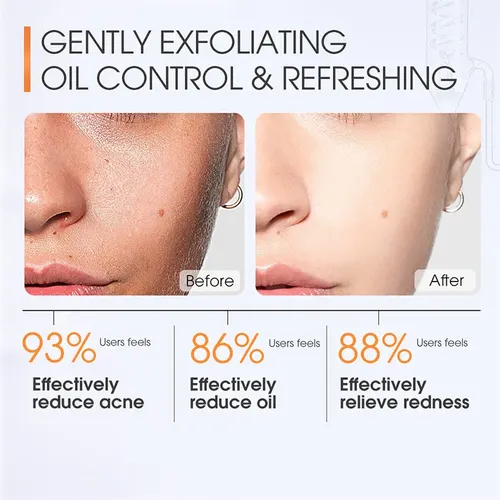 Limpiador Exfoliante Refrescante Con Ácido Salicílico