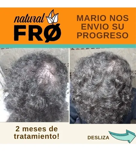 Locion Capilar Naturalfro Caida X 100ml + Shampoo Solido Kit