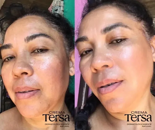 Mzcrema Tersa Despigmentante Quita Manchas Acné Paño De 40gm