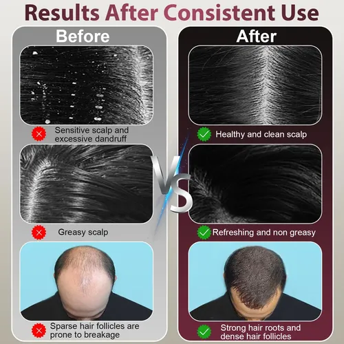 Peine De Terapia Láser Para Crecimiento Del Cabello Cwtul, R
