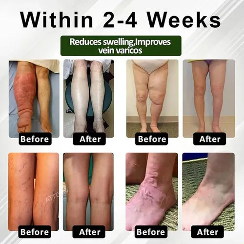 Crema Para El Cuidado De Las Piernas Para El Edema, Crema Pa