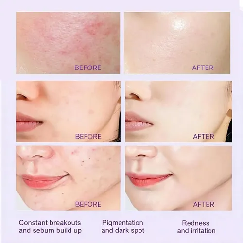 Crema Ácida: Crema Facial Hidratante Y No Pegajosa Para Una