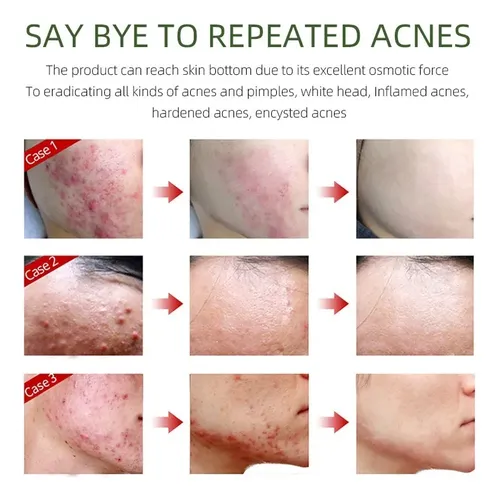 Tratamiento Facial Herbal Para Granos Y Brotes Recurrentes
