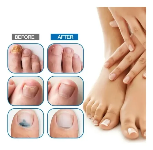 Laca Uña Manos Pies Cura Hongo + Suero Reparador Profesional Fragancia Neutra