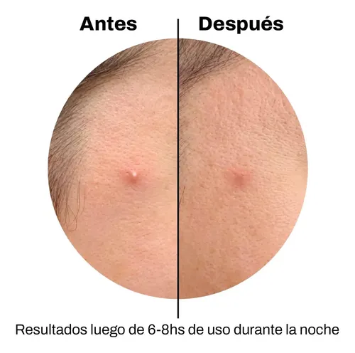 Parches Anti Acne Elimina Granitos Puntos Negros Grasa X72 Todo Tipo De Piel