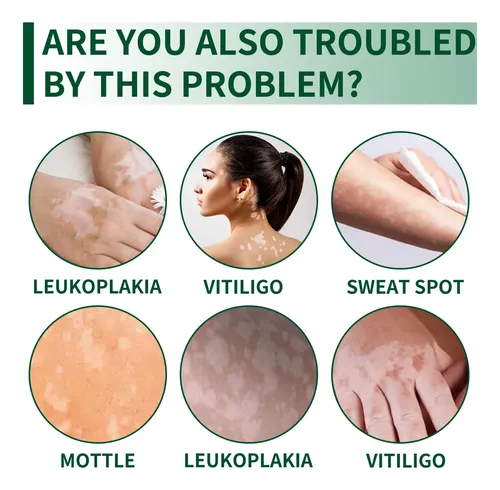 Zgq Una Crema Blanca For El Vitíligo, Aceite De Vitiligo K