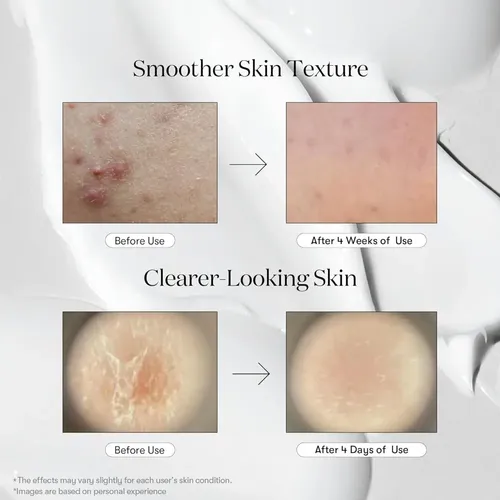 +esencia De Microagujas Para El Cuidado Y La Exfoliación De