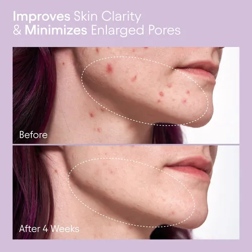 Tónico Líquido Alpyn Pore Perfecting Con 2% Bha Y Borraja 12