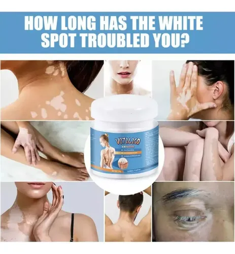 / Xpara Crema Para Vitíligo, Elimina Las Manchas Blancas.