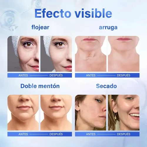 Cc///crema De Ácido Azelaico 20 /acné Y Tono Opaco//dd