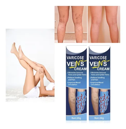 Crema Piernas Varices Estrias Formula Herbal Natural X2