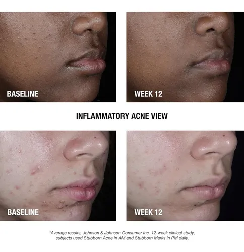 Tratamiento Facial Am Para Acné 2.5% Neutrogena