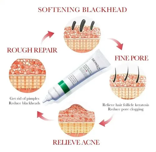 Bioaqua Creme Para Acné: Ácido Salicílico Para Piel ^.^