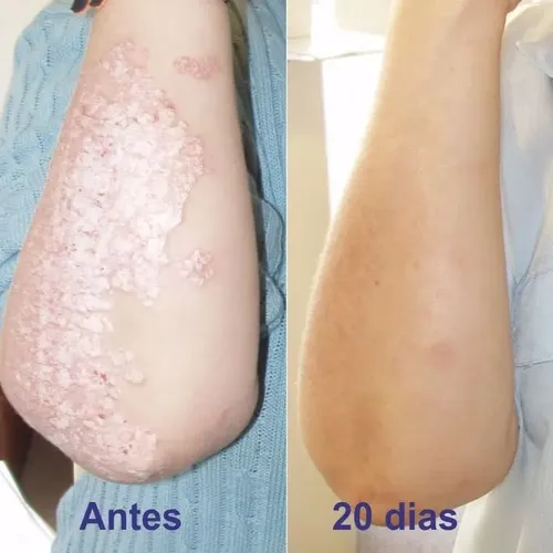 Psor Crema P/piel, Escamada, Reseca Ó Con Picazón