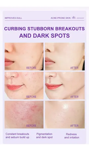 Crema Para Manchas Oscuras Para El Acné Con Ácido Azelaico A