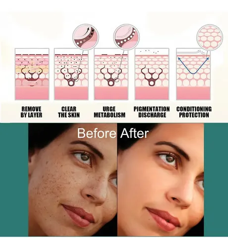 I Crema Iluminadora Facial Eelhoe Manchas Melasma Manchas Y