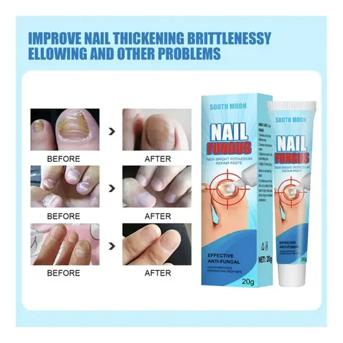 Crema Antifungico Uñas Onicomicosis Pies Manos Salud Hongos