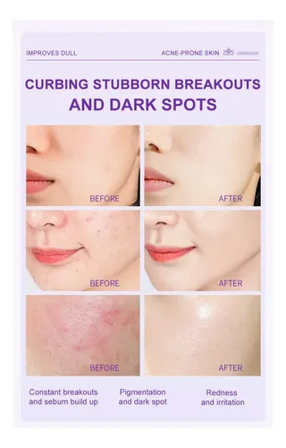 Crema Facial Hidratante Y No Pegajosa Con Un 15% De Ácido Az